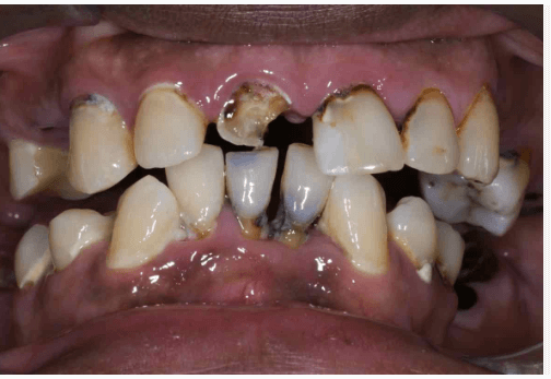 Baby:-J_Vmb6rmy0= Rotten Teeth