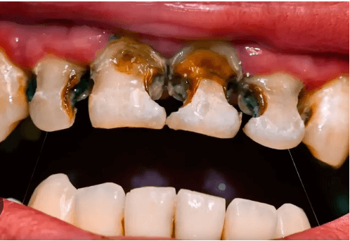 Baby:-J_Vmb6rmy0= Rotten Teeth